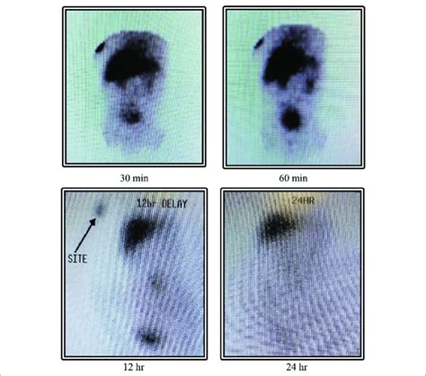 Hepatobiliary Iminodiacetic Acid Scan .